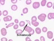 schistocytes